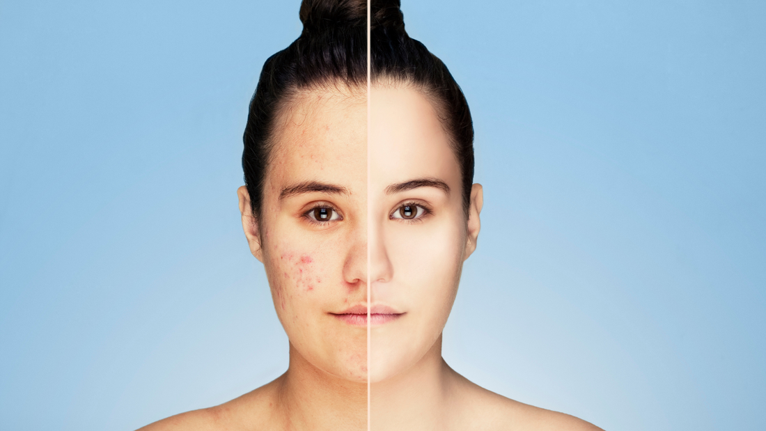 Top Acne Prevention & Healing Tips from a Holistic Nutritionist